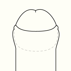 ヒアルロン酸